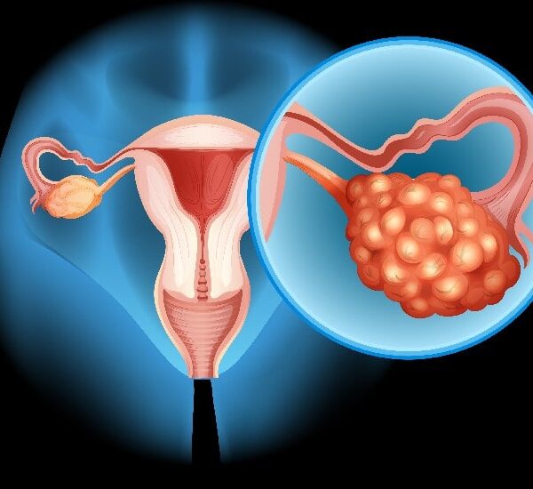 Ovario Poliquistico Tratamiento Quito Dra. Karina Aguirre Endocrinologa-min